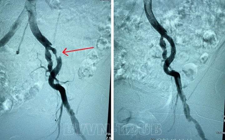 suyt-mat-chan-vi-nhung-trieu-chung-dau-nhuc,-te-bi-2-chan-keo-dai