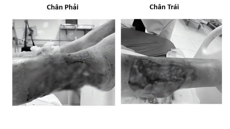 cuu-doi-chan-loc-da-khong-lanh-do-bien-chung-benh-dai-thao-duong-nghiem-trong