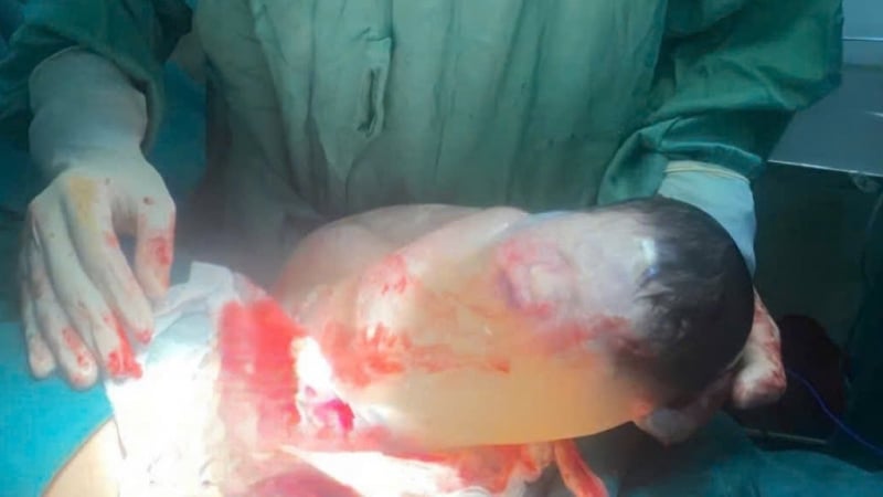 cuc-hiem-be-so-sinh-chao-doi-con-nguyen-trong-boc-oi,-cu-80.000-ca-sinh-moi-co-1-truong-hop