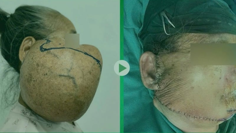 u-quai-treo-tren-mat-suot-40-nam,-nhu-tang-da-de-nang-cuoc-doi-cu-ba-nguoi-dan-toc-thai