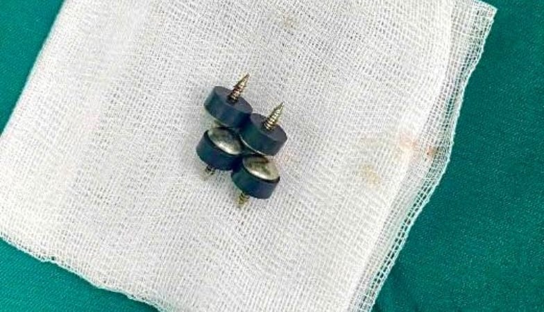 be-trai-2-tuoi-nuot-4-chiec-dinh-nam-chan-dau-nhon-gap-nguy-hiem