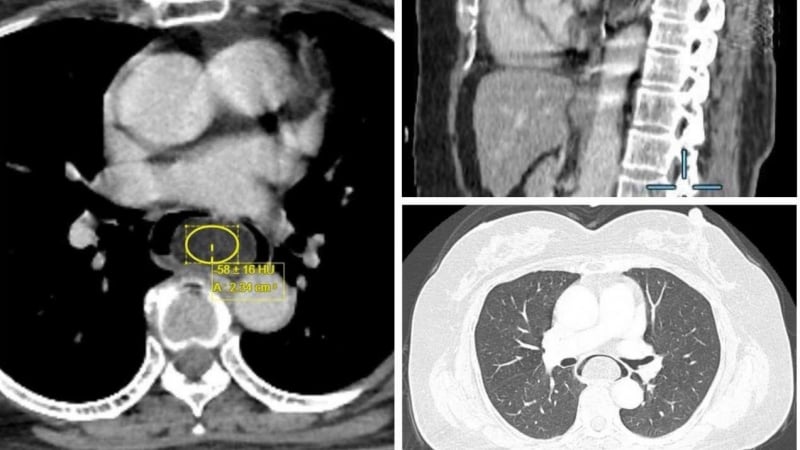 nuot-nghen-keo-dai,-bat-ngo-voi-thu-pham-nam-duoi-thuc-quan