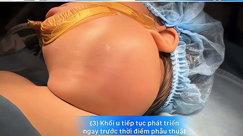 hot-hoang-khi-khoi-u-o-co-be-gai-lon-nhu-thoi-tung-gio,-chen-duong-tho,-khien-tre-nguy-kich