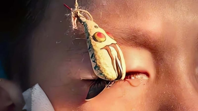 rach-mat,-thi-luc-giam-vi-di-cau-ca-bi-tai-nan,-bac-si-canh-bao-su-chu-quan-nguy-hiem