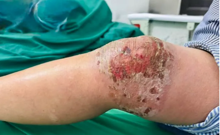 dap-thuoc-nam-tri-dau-khop:-tien-mat-tat-mang,-ruoc-them-nhiem-trung-nang-vao-nguoi