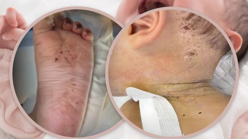 chan-dong-vu-em-be-10-thang-tuoi-nhap-vien-voi-600-vet-kim-bi-me-dam-de-chua-benh