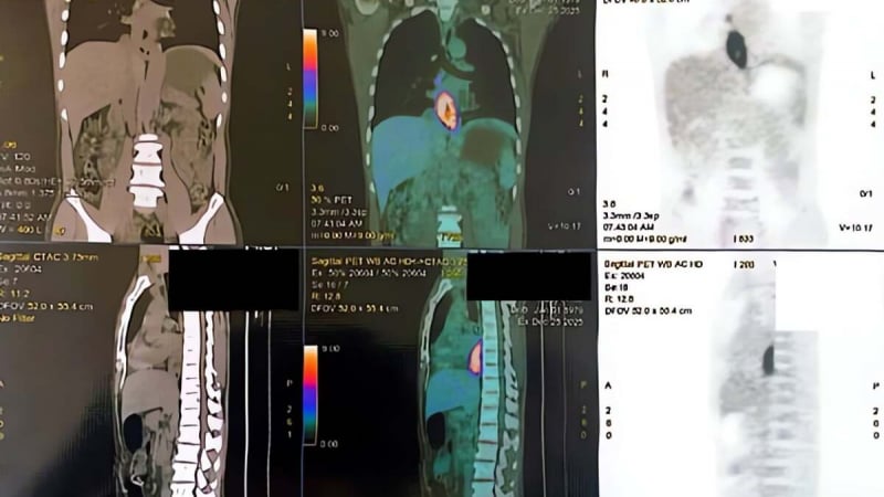 choang-vang-phat-hien-mac-2-loai-ung-thu-chi-tu-dau-hieu-nuot-kho,-sut-can