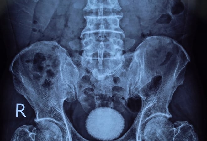 kinh-hai-vat-the-la-to-nhu-qua-trung-ngong-nam-gon-trong-bang-quang-nguoi-dan-ong-50-tuoi