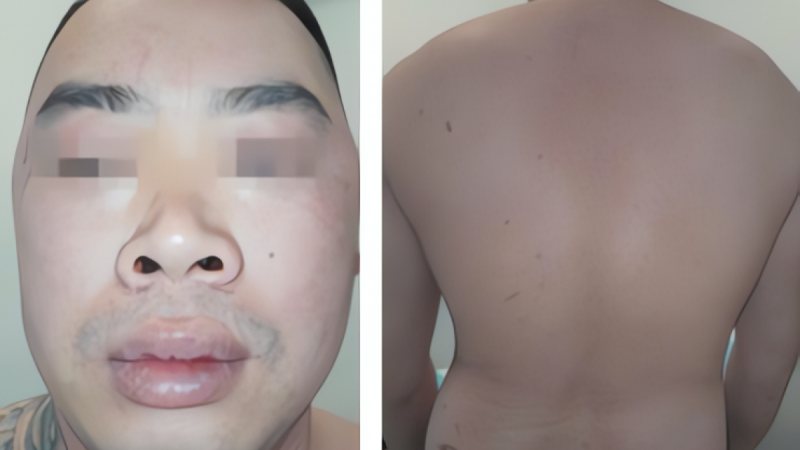 thanh-nien-duc-thuy-tinh-the-sau-khi-tu-y-su-dung-thuoc-corticoid-keo-dai-chua-may-day