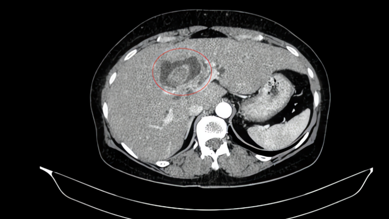 phat-hien-cung-luc-mac-2-loai-ung-thu-chi-tu-dau-hieu-vang-da,-ngua-nhieu