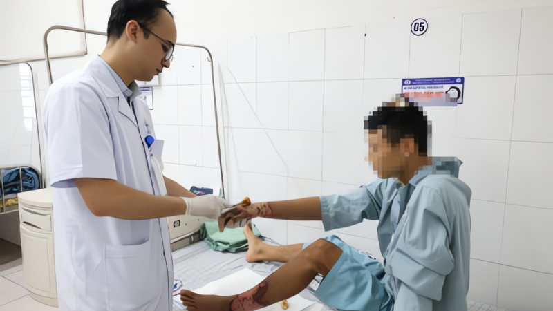 bong-nang-chan-tay-vi-mot-tai-nan-de-gap-khi-di-cau-ca