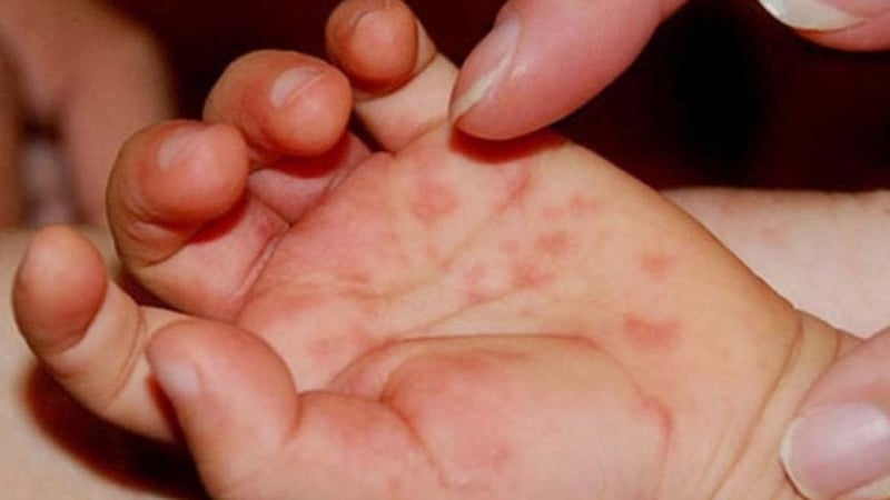 hon-25.000-ca-mac-tay-chan-mieng,-4-ca-tu-vong:-bo-y-te-chi-dao-khan