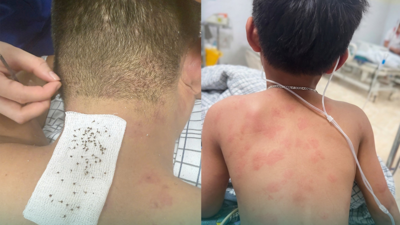 bi-hon-300-con-ong-mat-dot,-2-cha-con-nhap-vien,-ca-nguoi-toan-noc-doc