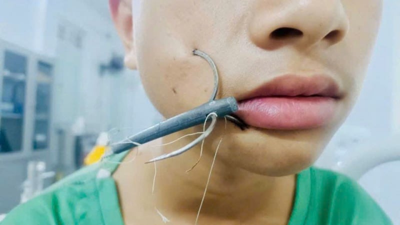 hi-huu:-be-trai-duoc-dua-den-trung-tam-y-te-voi-chiec-moc-cau-lon-cam-sau-vao-mat