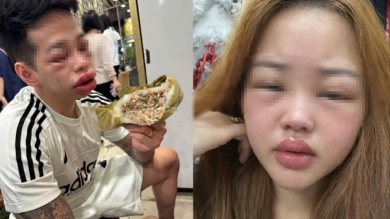 vi-sao-nhieu-nguoi-an-dac-san-banh-trung-kien-lai-bi-di-ung,-sung-phu-mat?