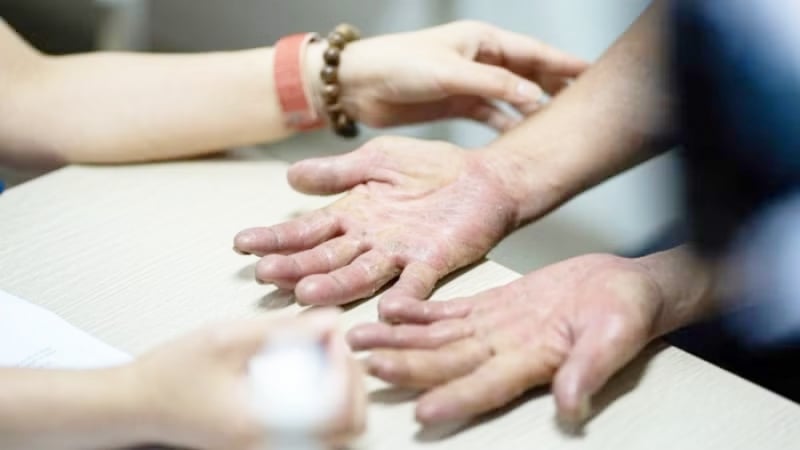 nhieu-nguoi-khon-kho-vi-benh-da-lieu-bung-phat-vao-mua-nang-nong