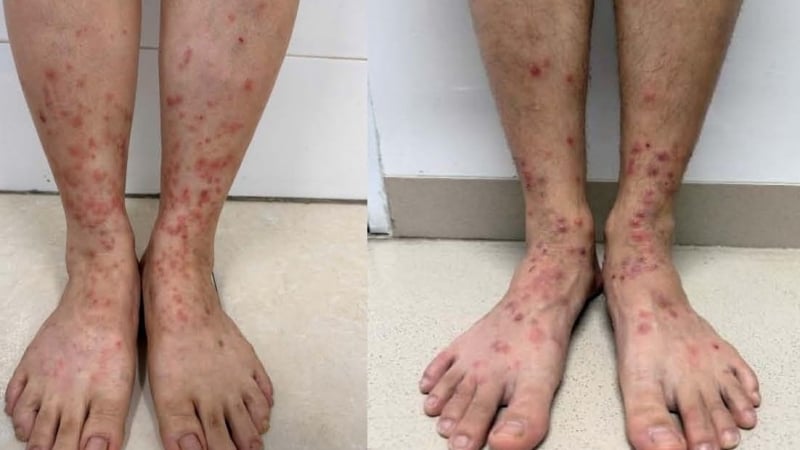 nhieu-nguoi-san-ngua,-kho-chiu-den-mat-an-mat-ngu-tu-ky-sinh-trung-khong-canh-nhay-tren-da