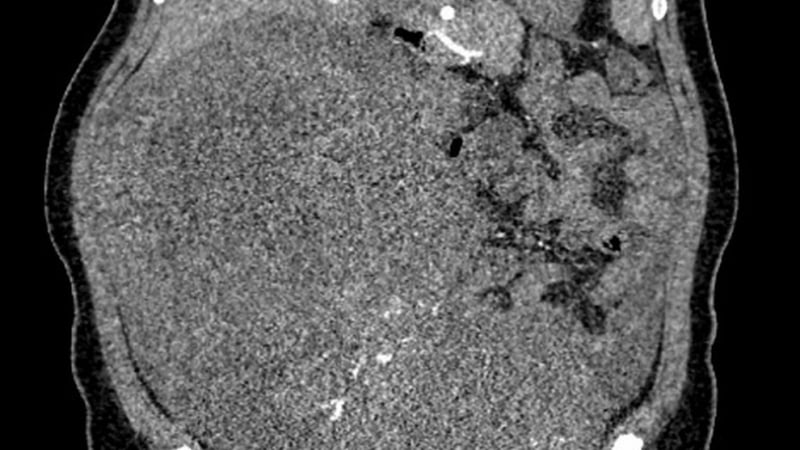 nguoi-phu-nu-mang-khoi-u-tu-cung-khong-lo-nang-toi-9kg