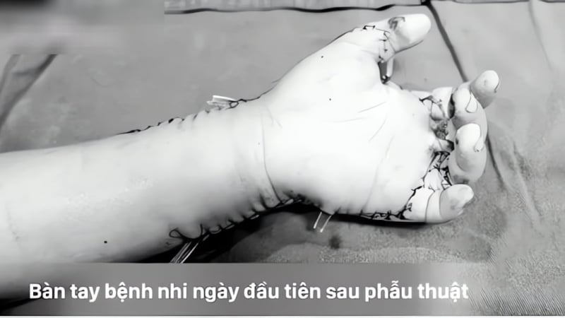 dua-ban-tay-vao-may-bao-vo-que-dang-chay,-be-trai-7-tuoi-bi-thuong-tich-nghiem-trong